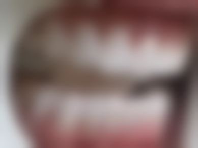 韩国 DIO 种植牙系统和奥齿泰哪个好？