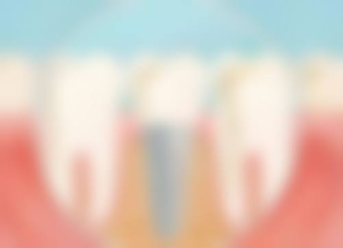 香港 微創植牙香港 手術過程：5個步驟話你知！