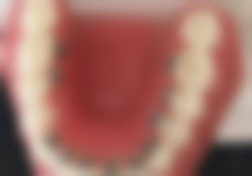 为什么要关注种植牙跟自己牙的区别