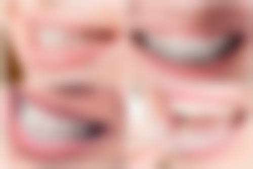 格倫菲爾口腔術前術後避坑指南（香港人必睇）