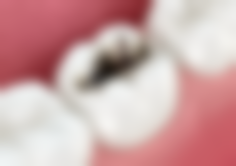 香港 澳門牙齒痛的藥有哪些 常見藥款分析