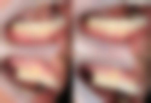 深圳牙科項目真相：香港姊妹更常問嘅3個問題