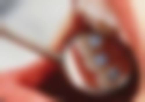 香港種植牙診所揀選指南：認住呢3個指標，唔使畀人呃！