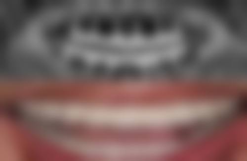 拓展延伸：香港種植牙常見問題大公開