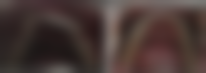 5. [戴牙套日常]隐形矫正的舒适感，是我之前没想到的