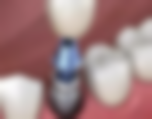 澳门种植牙术前术后避坑指南