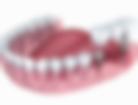 种植牙项目真相：澳门街坊更关心嘅3个问题