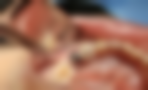 allon4植牙術前術後避坑指南：香港生活習慣版