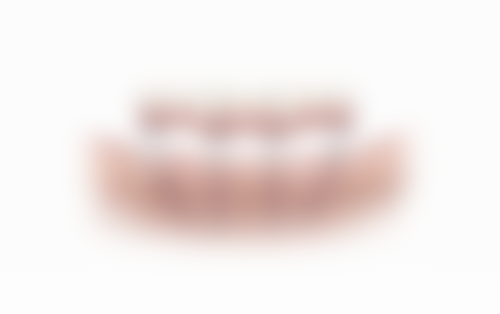 拓展延伸：allon4植牙香港常見疑問解答