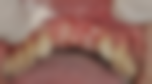 allon4植牙費用香港：邊間診所好？揀選3大關鍵