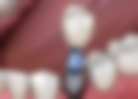 港大植牙收費2026：国有vs私立，點樣預約更抵？