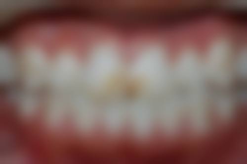 深圳牙科術前術後避坑指南：香港返工族/澳門妈咪注意事項