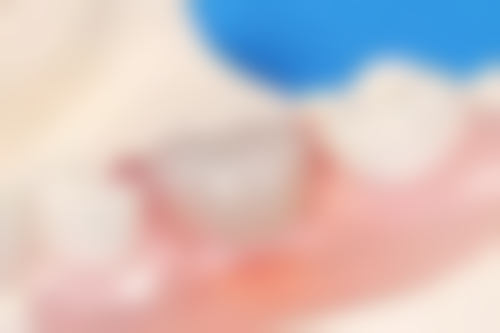 澳門看牙科醫院多少錢 術前術後避坑指南