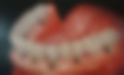 全口植牙費用香港：診所揀選3大要點