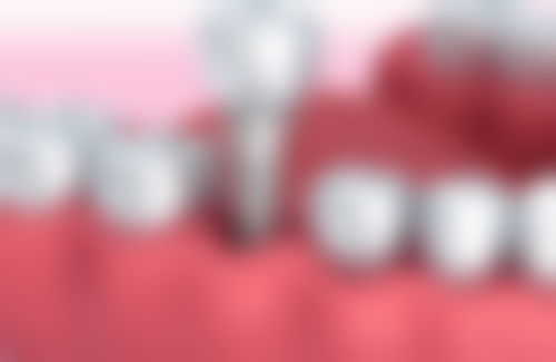 全口植牙術前術後避坑指南