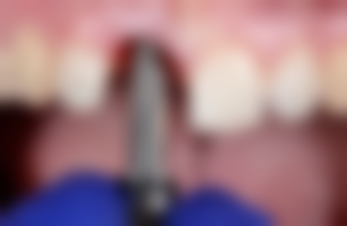 全口植牙費用香港2026｜價錢大公開！4萬-15萬元起收費價目表完整分享