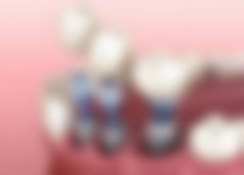 全口植牙關鍵選擇點：香港vs深圳邊個更適合你？