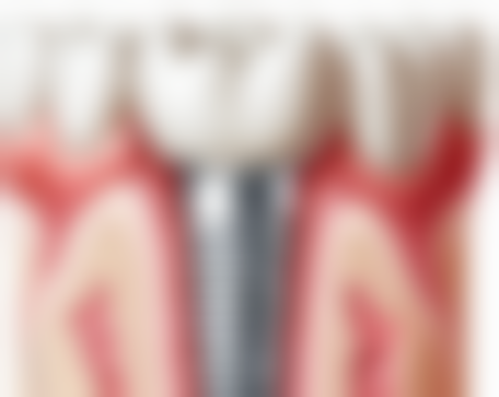 全口植牙費用香港：跨境種牙點樣更抵？