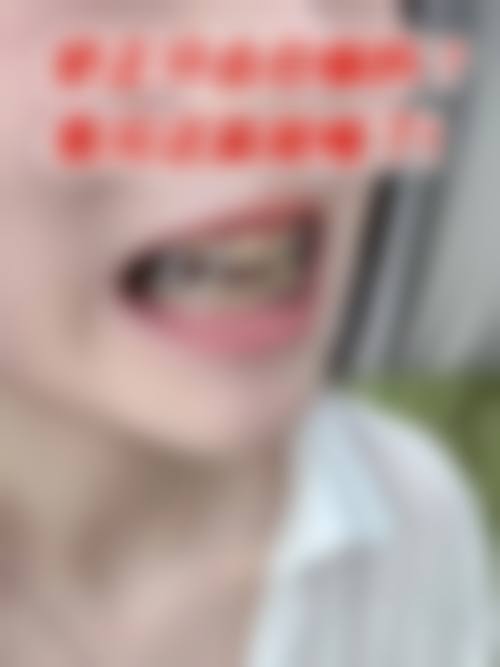 五、Lava牙冠的手术精细流程及术前术后服务