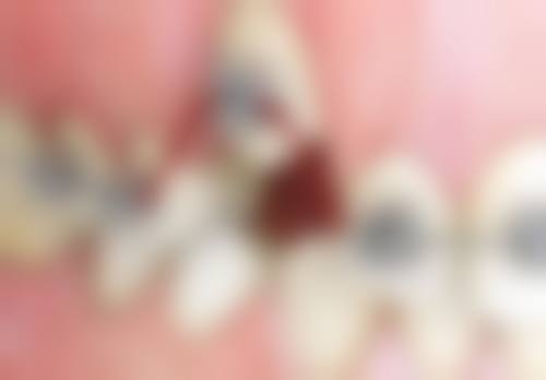 五、小孩地包天矫正的注意事项