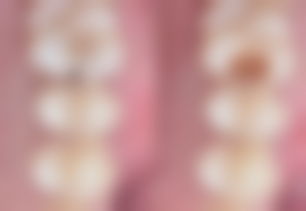 香港vs深圳整牙大比拼:邊樣更抵?