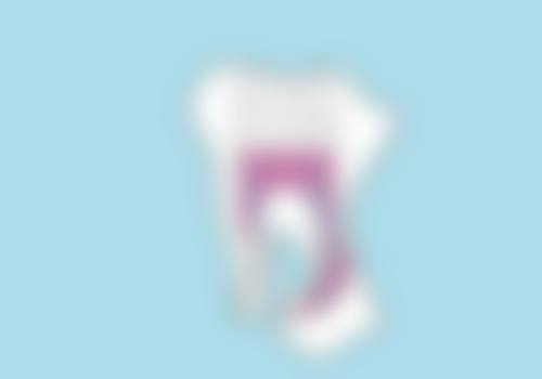 拓展延伸:根管治疗项目真相+关键选择点+避坑指南