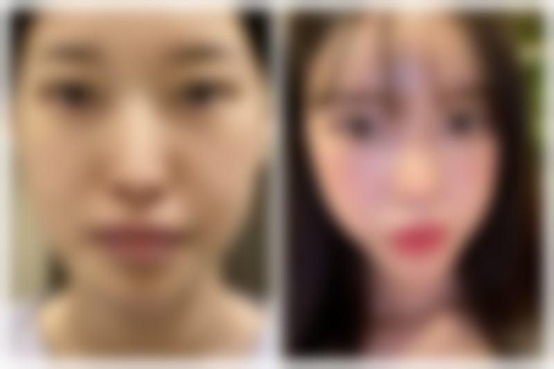 港大醫院整形外科價格表:適合邊類人群?