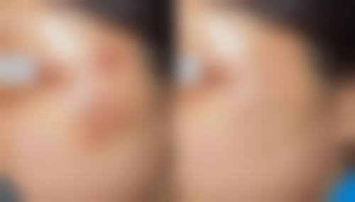 香港大學深圳醫院皮膚科放號時間:呢個時段搶號更易成功!