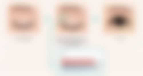 韓國必妩雙眼皮自然嗎？尹院長自然粘連法2026真人案例公開+中韓同價技術解析