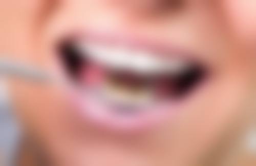 深圳牙科可唔可以微信預約 避坑指南:呢啲陷阱千祈唔好踩!