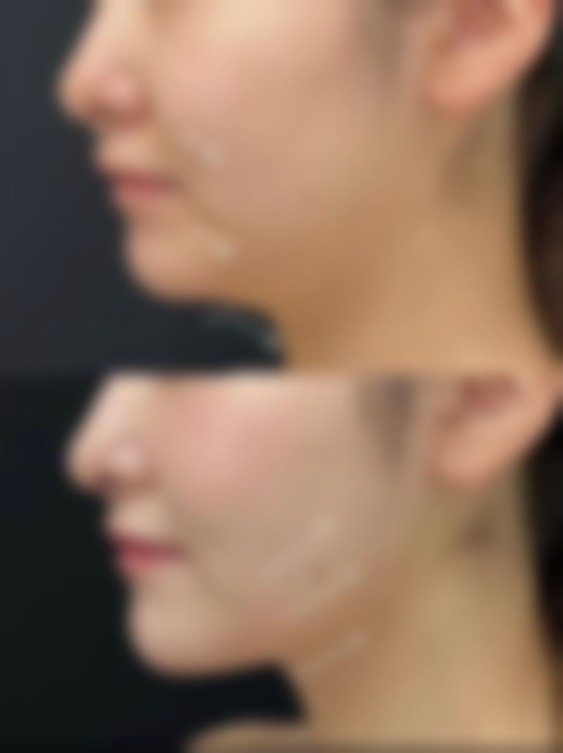 韓國醫美推薦毛孔粗大：揀診所必睇3大關鍵