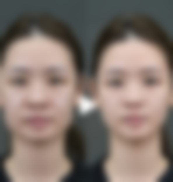 2. 韓國醫美推薦毛孔粗大：適合邊類人群？香港vs澳門姊妹點樣揀？
