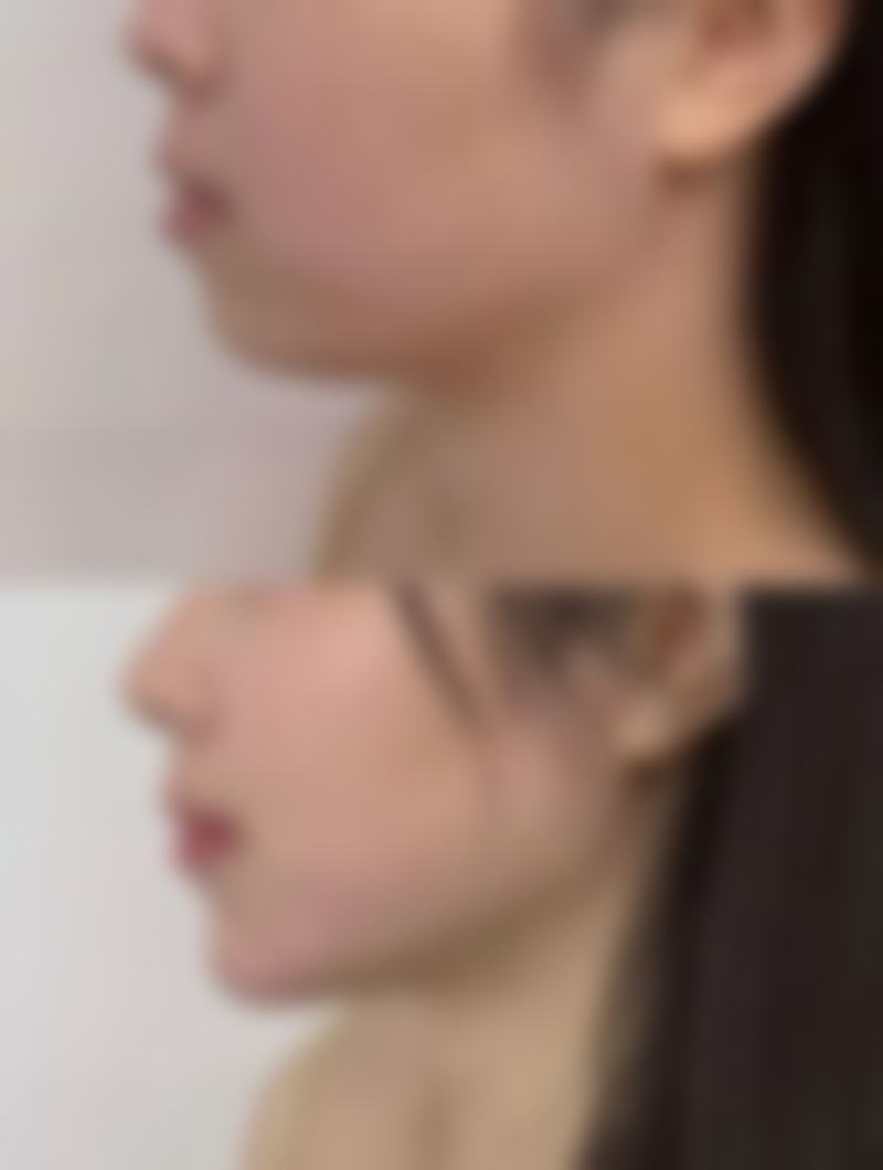 理性提醒:自然款雙眼皮,安心永遠排第一!