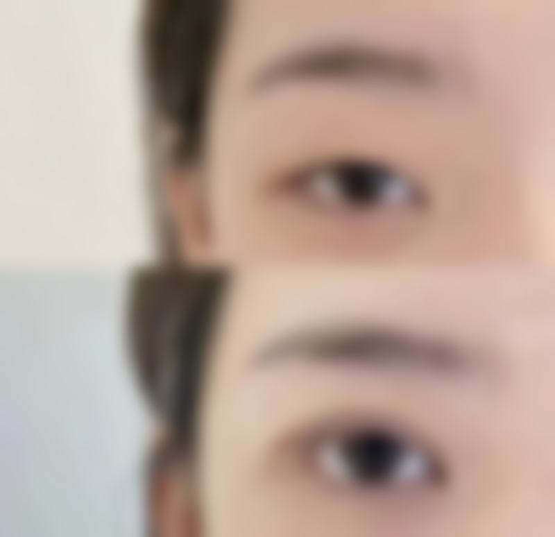 韓國男生雙眼皮推薦自然款2026:權威醫生實例對比