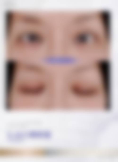 香港邊度割雙眼皮更好:適合邊類人群?3大眼型對應方案
