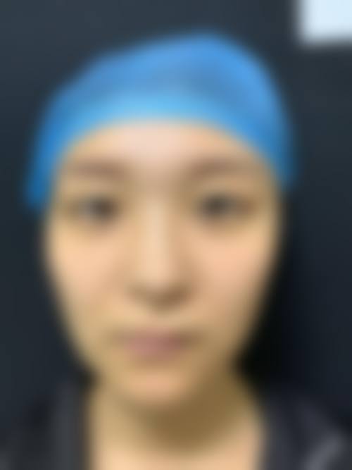 香港邊度割雙眼皮更好:診所揀選3大要點!附港大明星醫生推薦