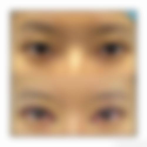 拓展延伸:香港割雙眼皮常見問題解答