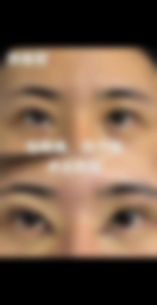 香港邊度割雙眼皮更好:埋線VS切開,邊樣成效更持久?