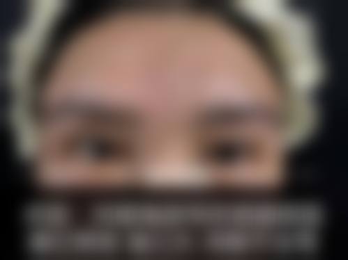 香港邊度割雙眼皮更好:術後護理避坑指南!返工/湊仔媽咪必睇