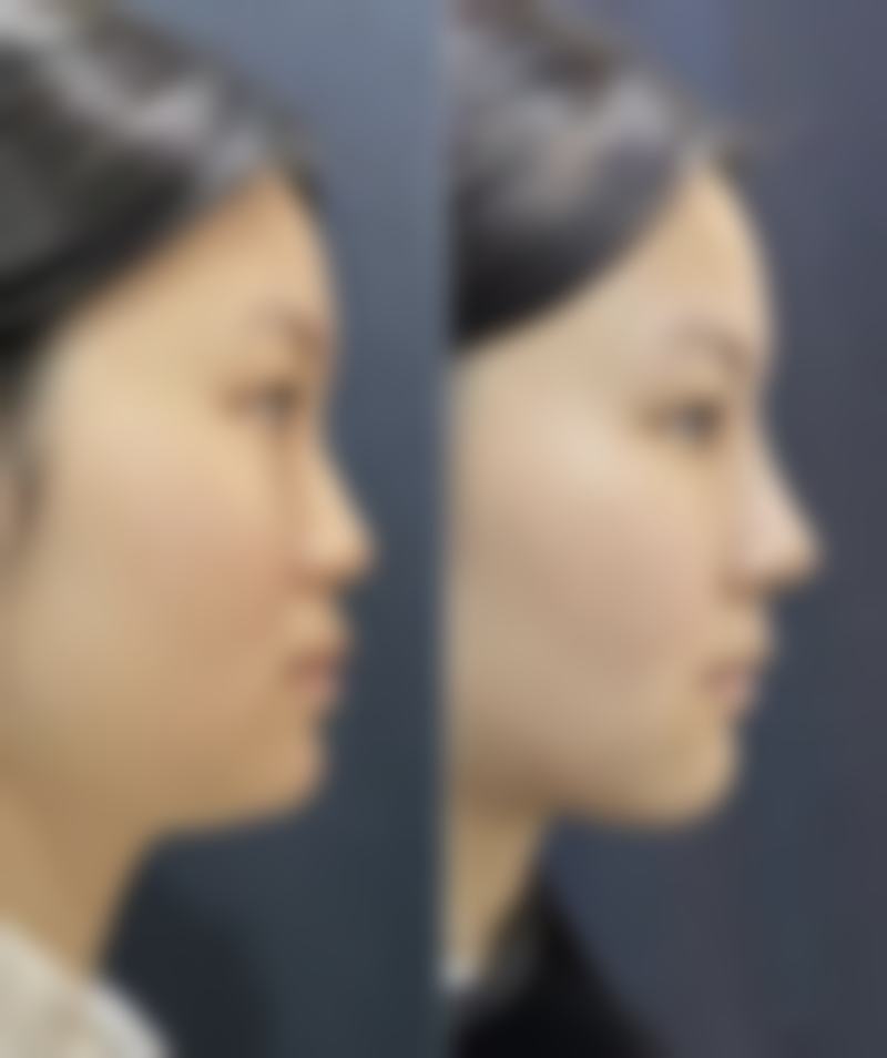 韓國安成烈整形醫院價格表2026中韓報價 技術特色:點解咁多人揀?