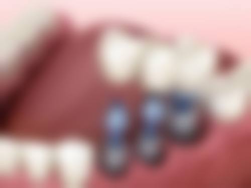珠海種牙多次真相:呢啲「伏」千祈唔好踩!