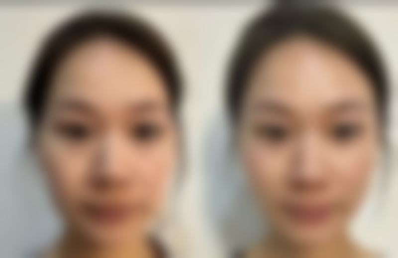 十、相关科普内容推荐——注射美容之玻尿酸填充