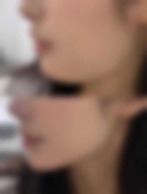 五、面部吸脂真实经历