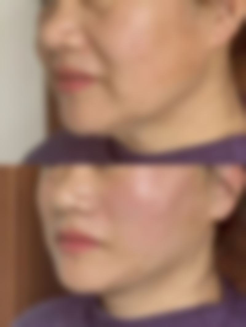 港澳姊妹術後護理貼士:返到屋企點樣維持成效?