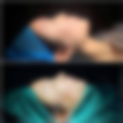韓國鼻整形會唔會頂到發亮 術後成效點樣?