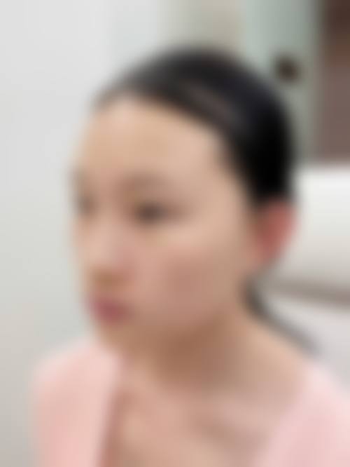 韓國鼻整形會唔會頂到發亮 價錢範圍(HKD/MOP)
