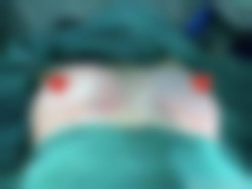 韓國自體脂肪隆胸存活率高嗎 3招提存不結塊秘訣