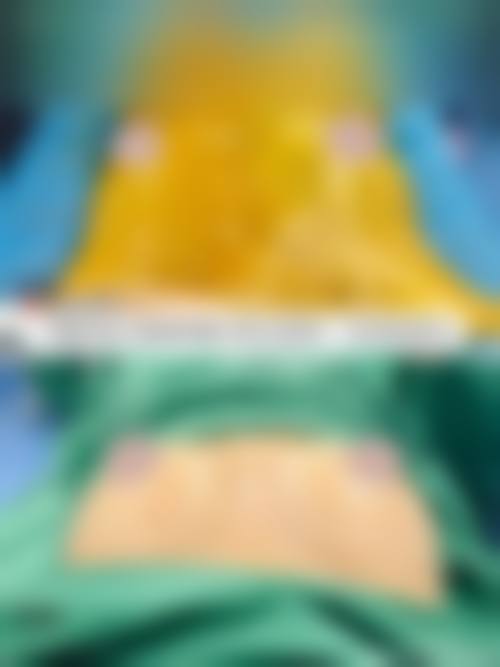 韓國自體脂肪隆胸存活率高嗎 診所揀選要點(香港/澳門)