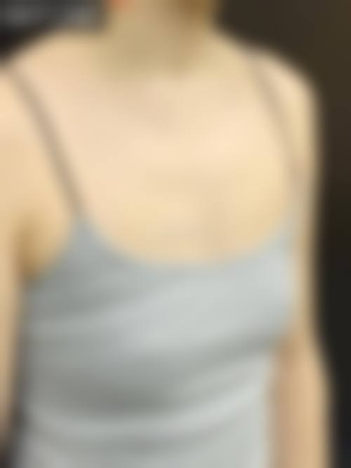 韓國自體脂肪隆胸存活率高嗎 適合邊類人群?