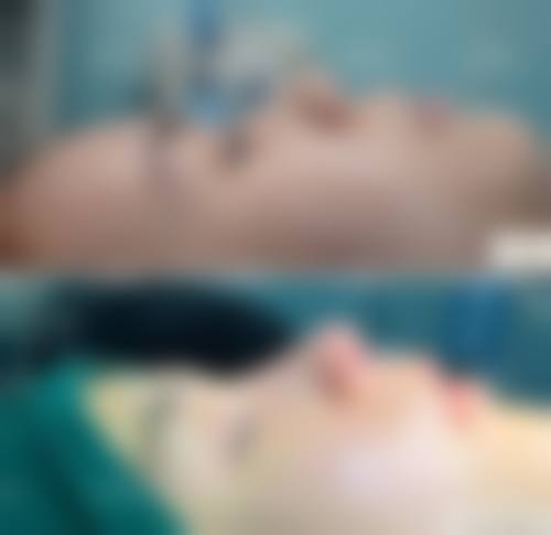 韓國鼻整形會唔會頂到發亮 適合邊類人群?